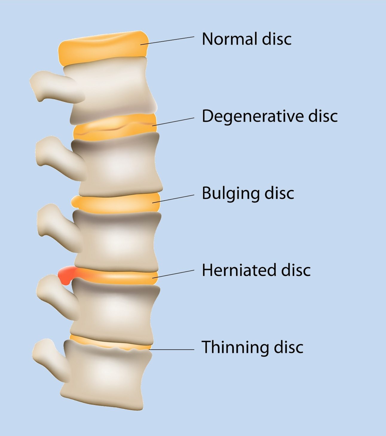 Disc' and 'Disk': Is There a Difference?
